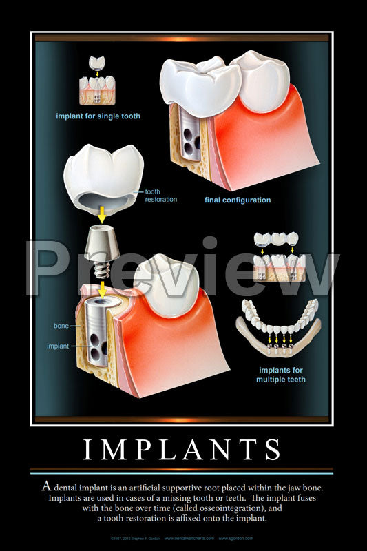 Implants Wall Chart