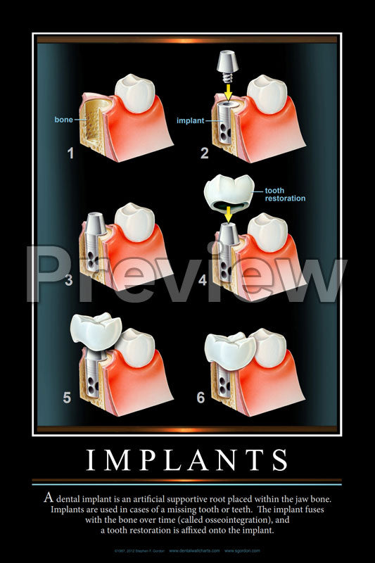 Implants #3 Wall Chart