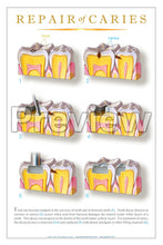 Load image into Gallery viewer, Repair of Caries #3 Wall Chart