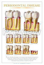 Load image into Gallery viewer, Periodontal Disease Wall Chart