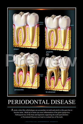 Periodontal Disease #2 Wall Chart