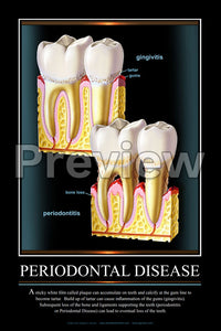 Periodontal Disease #3 Wall Chart