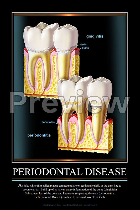 Periodontal Disease #3 Wall Chart