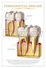 Load image into Gallery viewer, Periodontal Disease #3 Wall Chart
