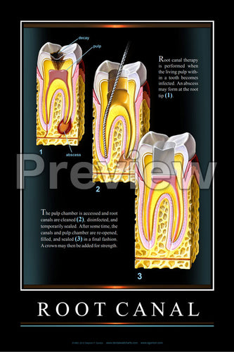 Root Canal #2 Wall Chart
