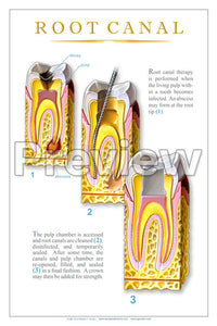 Root Canal #2 Wall Chart